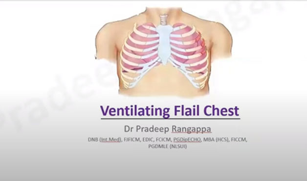 Flail Chest Ventilation